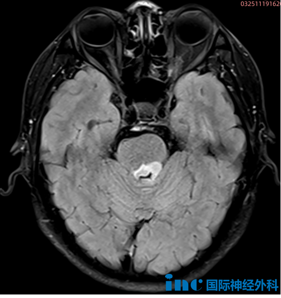 “巴教授可以盡快為我手術(shù)嗎？”12月下旬，他們與德國(guó)神外大咖攜手奔赴“生命之約”